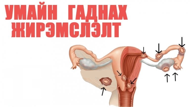 УМАЙН ГАДНАХ ЖИРЭМСЛЭЛТ ГЭЖ ЮУ ВЭ? /НӨАГ-ын Эх барих эмэгтэйчүүдийн эмч, Клиникийн профессор,  Дурангийн мэс засалч, Тэргүүлэх зэргийн эмч  Б.Дашдэмбэрэл/
